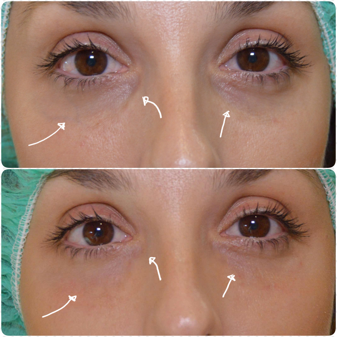 Tipos de ojeras y cómo quitarlas Dr Edward SerranoDr Edward Serrano