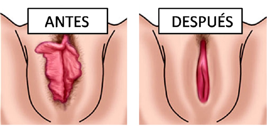 Inflamación del labio