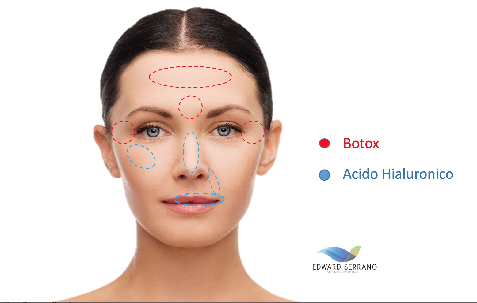 diferencias botox y acido hialuronico