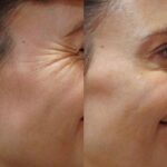 botox