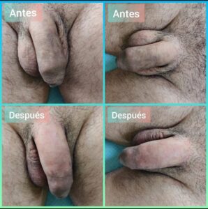 engrosar pene sin cirugia