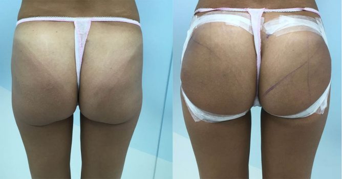 aumento de gluteos con acido hialuronico