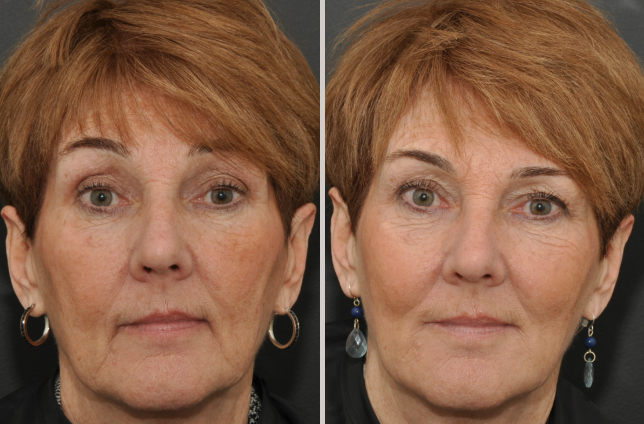 acido hialuronico para arrugas