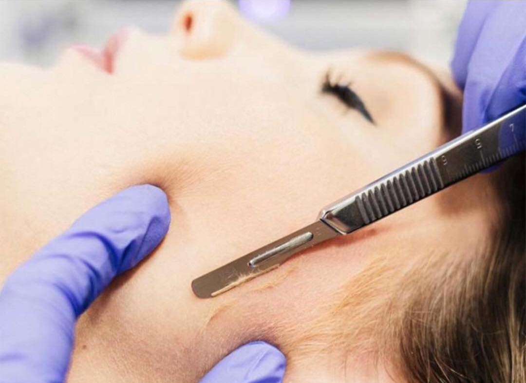 Dermaplaning beneficios o consecuencias