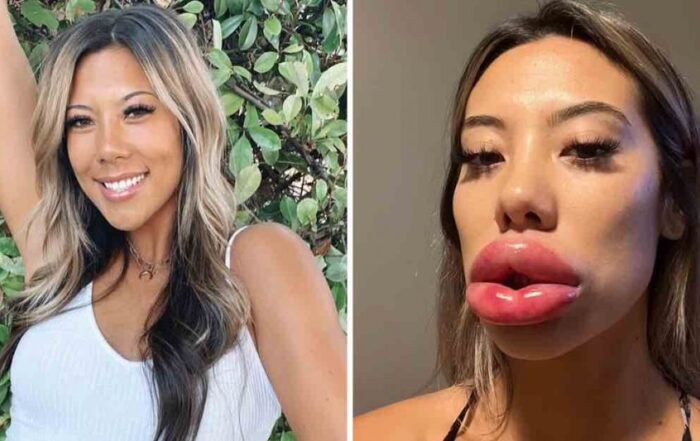 Labios de Pato como evitarlos