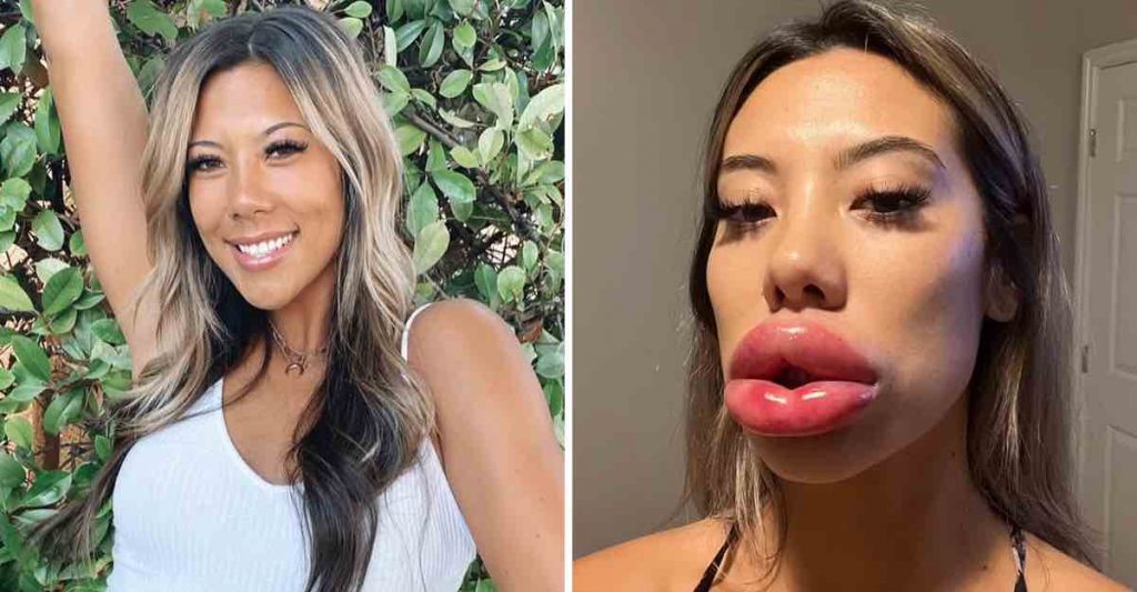 Labios de Pato como evitarlos